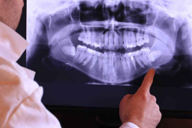 Best Dentist for Tooth Abscess  in Mcswain, CA