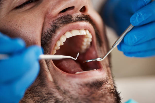 Best Teeth Whitening  in Mcswain, CA