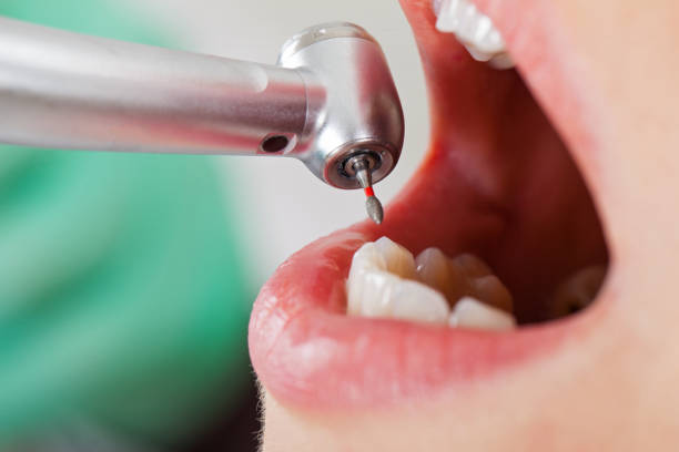 Best Emergency Tooth Extraction  in Mcswain, CA